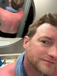 Hi all, random one, I'm seriously burnt to the point I can't bear to wear a  bra/bikini top as my back is so sore! Any sure fire sunburn remedies? I  burnt Friday