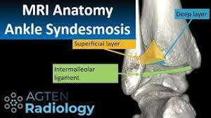 Maybe you would like to learn more about one of these? Distal Tibiofibular Syndesmosis Physiopedia
