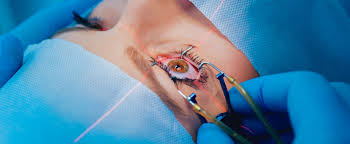 However, the time may vary if an ophthalmologist must operate on both eyes in one session. Limitations Of A Laser Surgery Who Is This Surgery Not Suited For
