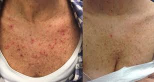 Cancerous tumors are characterized by cell division, which is no longer controlled as it is in normal tissue. Before After Dermassociates Rockville U S Dermatology Partners