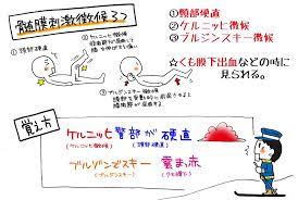 髄膜刺激症状 徴候 の種類3つの覚え方 ケルニッヒ警部が硬直 ブルゾンでスキー 雲まっ赤 で覚えてみよう マンガで看護師国家試験にうかーる 看護ノート 看護師 看護学生