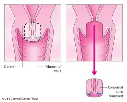 Doctors can often find and treat the problem before it turns into cancer. Cone Biopsy Surgery Jo S Cervical Cancer Trust