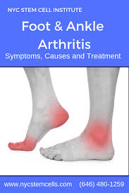 Regenerative Medicine Stem Cell Therapy For Foot Ankle Arthritis Ankle Arthritis Stem Cell Therapy Arthritis