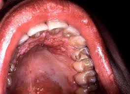 HPV