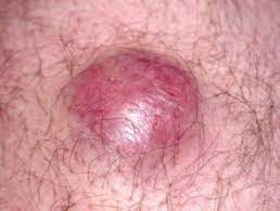 These cells are near the nerve endings and they help us respond to touch. Merkel Cell Carcinoma Dermnet Nz