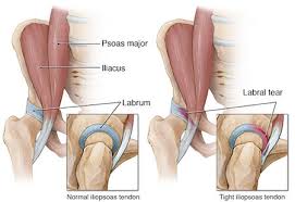 Image result for Hip Labral Tear