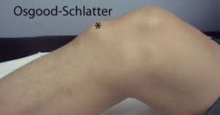 Managing Osgood Schlatters Disease Http Www Sydneyphysioclinic Com Au Injury Rehabilitation Managing Osgood Schlatters Disease