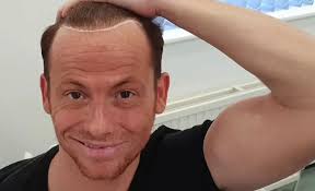 Joe Swash Hair Transplant: Looking at Joe's Hairline