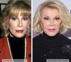 Joan Rivers Before and After Plastic Surgery