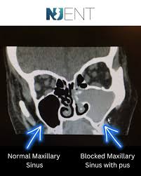 Image result for Sinus CT