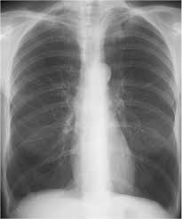 Im Emma Part I Lungs Chest X Ray Copd Asthma Other Lungs Flashcards Quizlet
