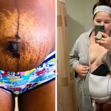 Dieser schnitt wurde zumeist horizontal an der gebärmutter ausgeführt und erfolgte am rand der schambehaarung. 14 Frauen Teilen Fotos Von Ihren Korpern Nach Der Entbindung Und Ich Find S Einfach So Schon