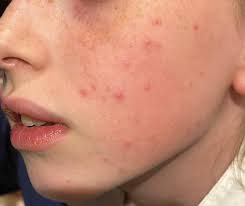 Any advice for summer skin and hair issues in kids?