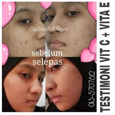 So named because it makes the skin look like that. Parut Chicken Pox Boleh Hilang Dengan Cepat Anda Boleh Amalkan Sendiri Nanti Ziana Eunos