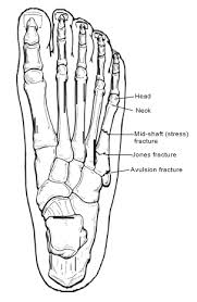 These are very common and usually happen at the same time as a sprained ankle. Foot Ankle Fractures Foot Ankle Specialists Bellevue Ne