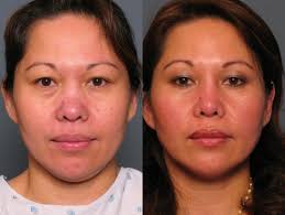 Top Asian Rhinoplasty Doctors in Raleigh, NC