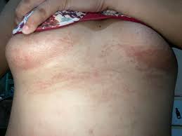 Image result for Candidiasis under breasts