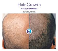 Hair stem cell therapy is one of the most innovative techniques in the field of hair treatments, thanks to the last advances in stem cells. Hair Restoration Using Procell Stem Cell Microneedling