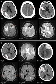 Temporal and Spatial Clustering of Intracerebral Hemorrhage in Cerebral  Amyloid Angiopathy | Neurology
