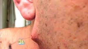 Ingrown hair symptoms & signs. Here Are 5 Things That Give You Nasty Ingrown Hairs Ratemds Health News