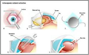 Image result for Cataract Extraction