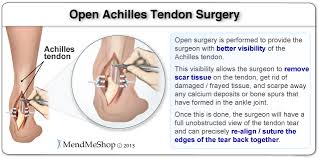After surgery for a ruptured achilles tendon ,consult with an orthopedic surgeon to determine treatment and rehabilitation. Post Surgery Rehabilitation Achilles Tendonitis