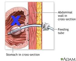 Trick Of The Trade Deflate An Undeflatable Gastrostomy Tube