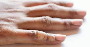 Burn injury degree categorizations in dc. Types Of Burns By Degree First 2nd 3rd Degree Burns