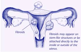 Symptoms of uterine fibroids vary. Uterine Fibroids Capital Women S Care Md Dc Va