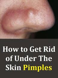 That thing might not even be a zit at all. Blind Pimples What Causes Them And How To Get Rid Of Them Blind Pimple Hard Pimple Under Skin Beauty Tips For Glowing Skin