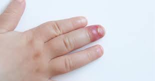 It makes sense that the filing of the nails and then the application of glues and acrylic shrink up and pull on the nails and thats what makes them sore. Fingernail Infection Paronychia