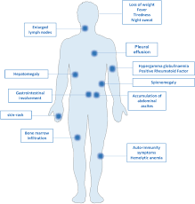 Angioimmunoblastic t cell lymphoma (aitl) is a peripheral t cell lymphoma characterized by systemic disease, a polymorphous infiltrate involving lymph nodes, and a prominent proliferation of high endothelial venules and follicular dendritic cells (who 2008). New Preclinical Models For Angioimmunoblastic T Cell Lymphoma Filling The Gap Oncogenesis