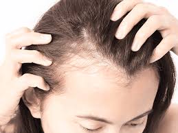 Quelle coupe de cheveux courte. L Alopecie Androgenetique Chez Les Femmes