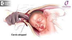 Methods Of Labour Induction Dr Padmini Isaac Cloudnine Hospitals Youtube