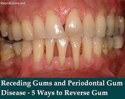 What is canine dental disease? Receding Gums And Periodontal Gum Disease 5 Ways To Prevent Gum Recession Gum Disease Treatment Gum Treatment Gum Health