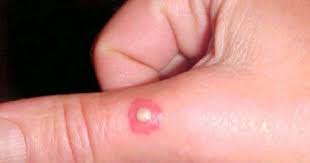 Pin On Brown Recluse Spider Bites