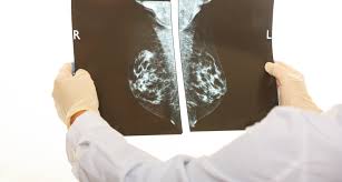 Wie wird eine mammographie technisch durchgeführt? Mammographie Screening In Schleswig Holstein Noch Zu Wenig