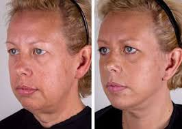 As the skin ages, it starts to lose some of. Exercise For Getting Rid Of Jowls Jowl Exercises Jowl Facial Exercises