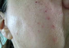 There are many treatments available for sebaceous hyperplasia and all come with risks. Little Known Treatment For Sebaceous Hyperplasia Lynda Makara