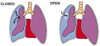 Aug 18, 2020 · surgery for lung cancer can often be curative when it is caught in the earlier stages, but there are many factors to consider in deciding whether it is right for you. Flail Chest Pneumothorax Tension Pneumothorax And Chest Drains Nursing 101