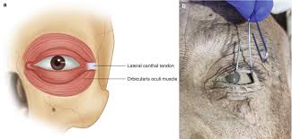 Image result for Lateral Canthotomy