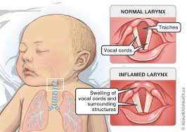 Image result for Croup