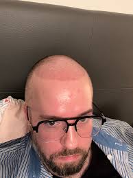 May your hairline move 2cm back each time you ignore my posts  👨🏼‍🦯🥱🥱🥱🥱🥱🥱