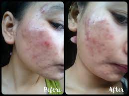 Karena tidak mengandung alkohol maka mediklin ungu tidak menyebabkan rasa perih pada kulit saat. Review Medi Klin Tr Gel