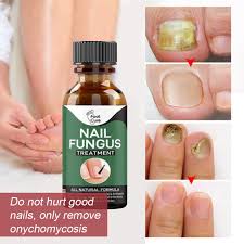 How to get rid of nail fungus naturally. Best Fungus Cream Nail Treatments 2021 Aliexpress