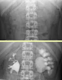 Image result for Intravenous Pyelogram