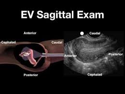 Sonographic Anatomy Of Female Pelvis Simplified Approach Youtube Medical Ultrasound Diagnostic Medical Sonography Ultrasound Technician