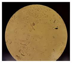 Nephrolithiasis Concise Medical Knowledge
