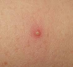 Ingrown hairs are hairs that curl and grow back into your skin after shaving or waxing. Folliculitis Wikipedia