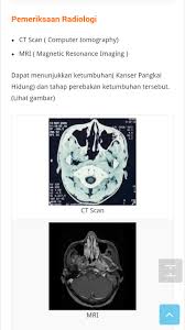 Kanser hidung merupakan kanser jenis malignan (kanser yang merebak) yang terbentuk pada tisu sinus dan juga kanser hidung ini terbahagi kepada dua jenis: Disini Segalanya Bermula Kanser Hidung
